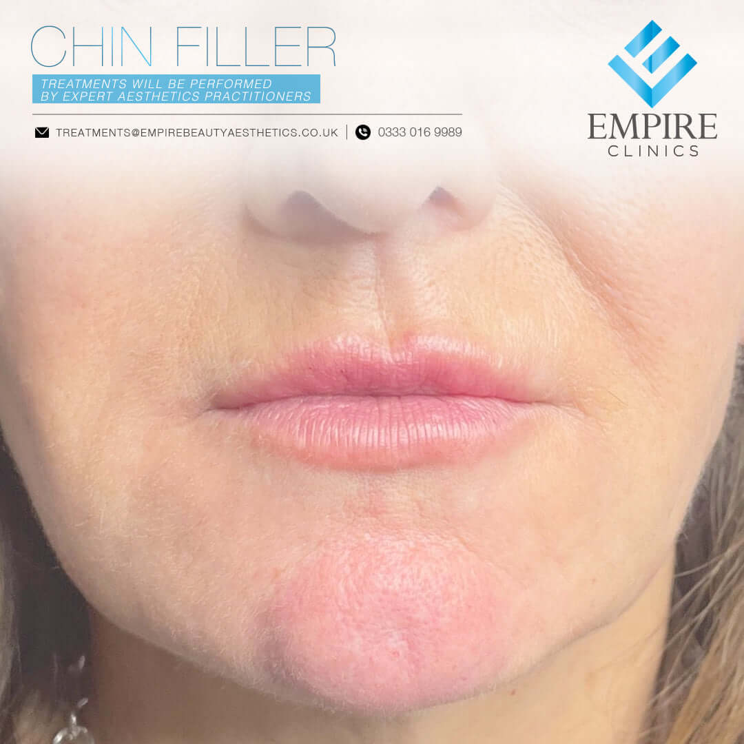 Chin dermal filler injections in Liverpool